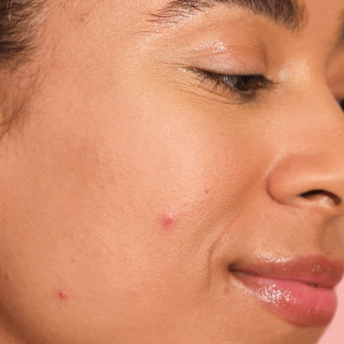 Period Skin: Why You Break Out Around Your Cycle (And What To Do About It)